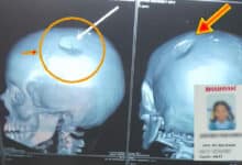 Sixth Class Girl Suffers Skull Fracture After Teacher Beats Her
