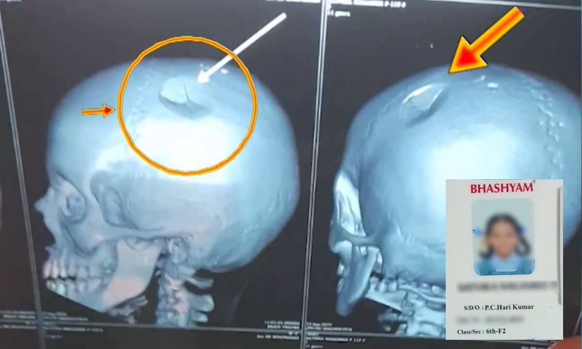 Sixth Class Girl Suffers Skull Fracture After Teacher Beats Her